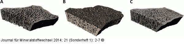 Bone Erosions