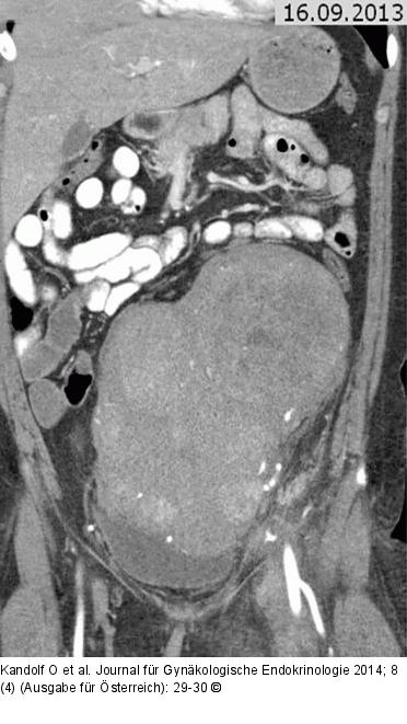 Vense Thromboembolie