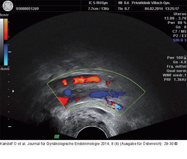 Vense Thromboembolie