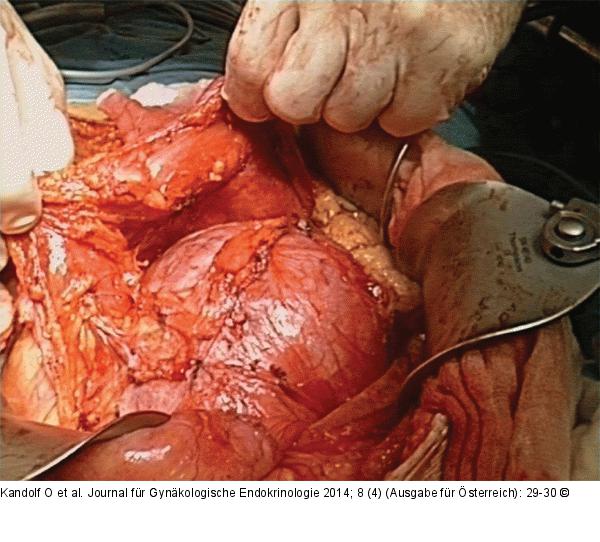 Uterus myomatosus