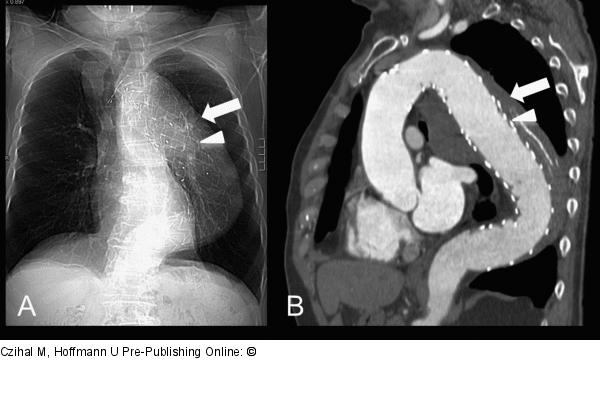 Aorta thoracalis - Aortenruptur