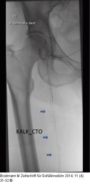 CTO-Revaskularisation