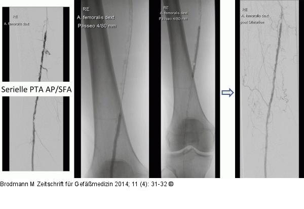 CTO-Revaskularisation