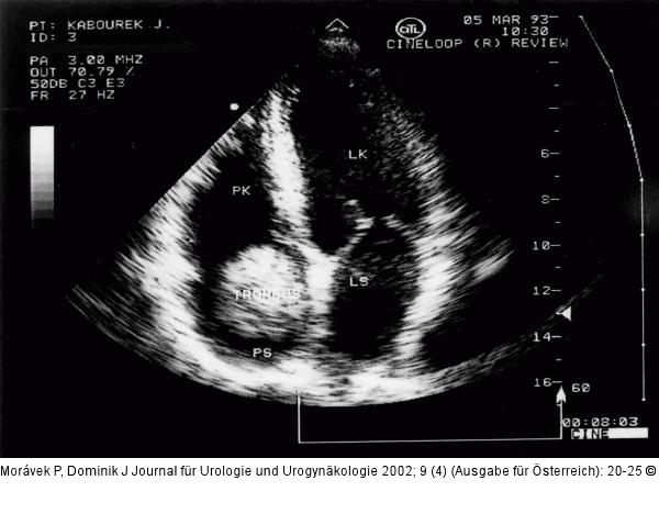 Nierenkarzinom - Tumorthrombose