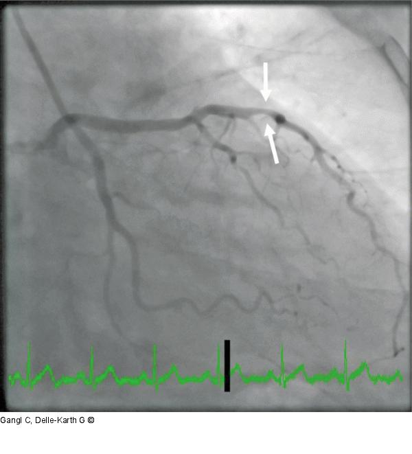 NSTEMI