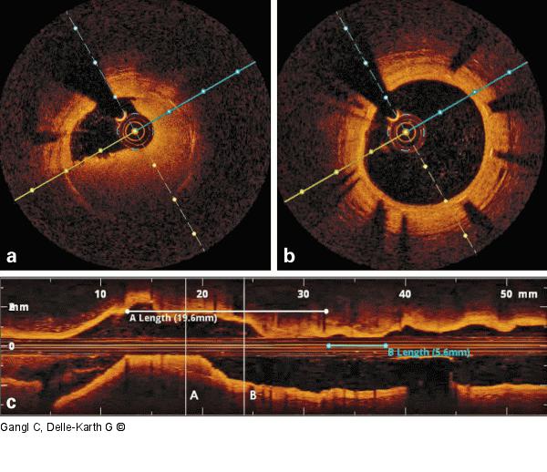 Thrombus - Stent 