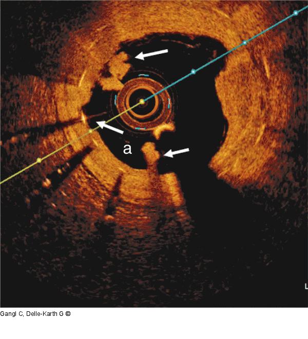 Thrombus