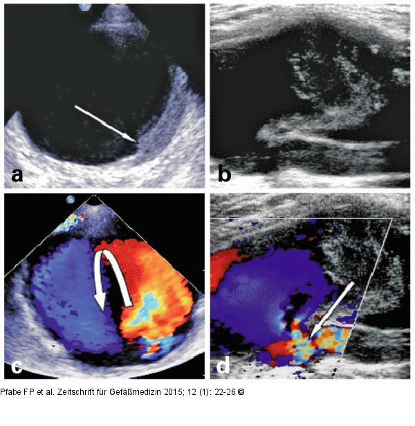 Aneurysma