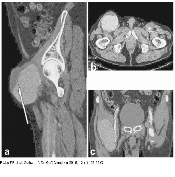 Aneurysma