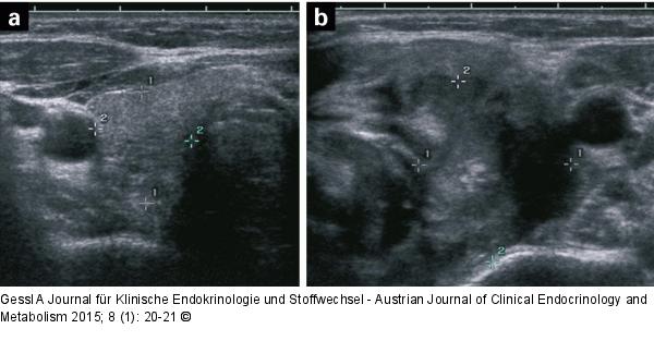 Thyreoiditis