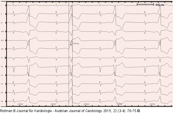 EKG