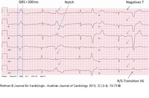 EKG
