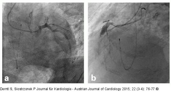 Coronary Angiography