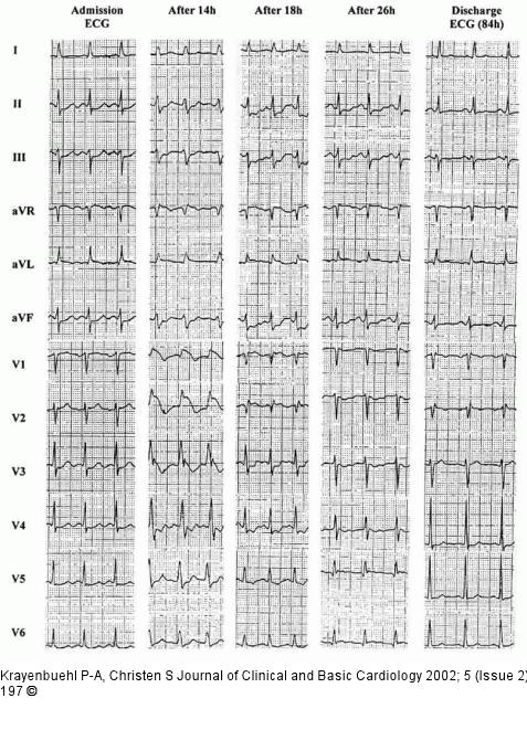 EKG - Trizyklika - Myokardinfarkt