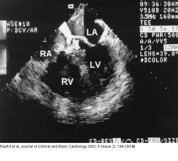 Sinus-Valsalvae-Aneurysma