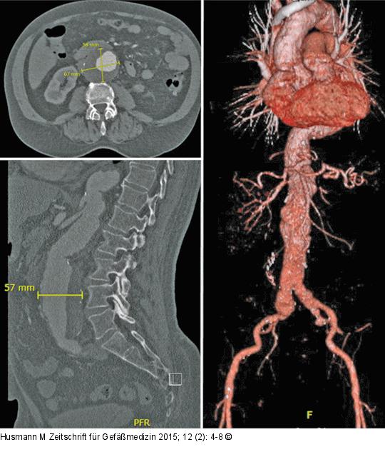 Aortenaneurysma