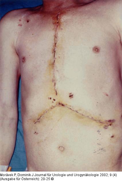 Nierenkarzinom - Tumorthrombose
