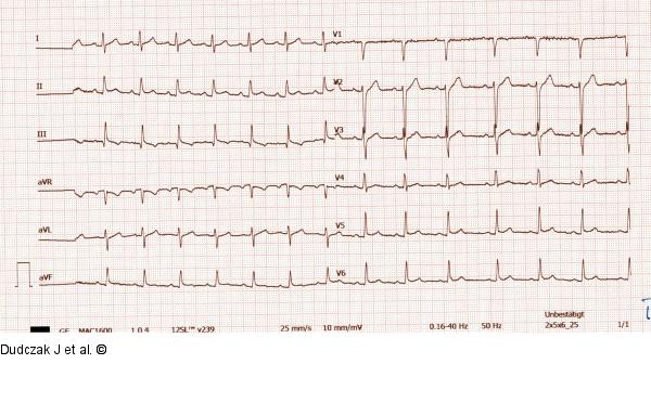 EKG