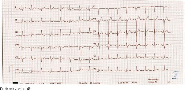 EKG