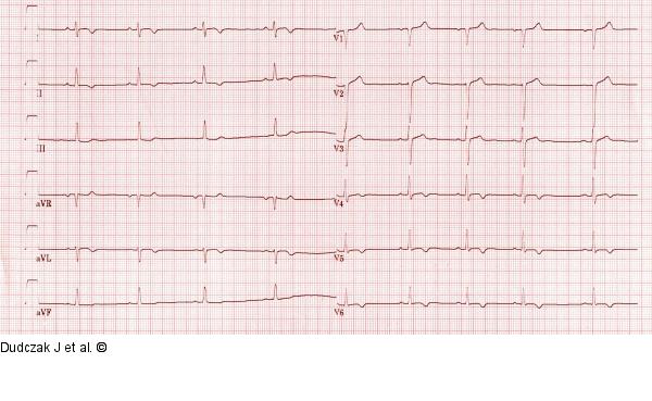 EKG