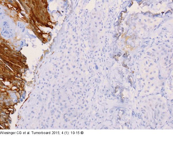 Tumor
