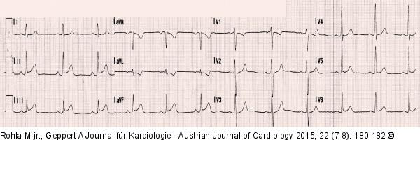 EKG