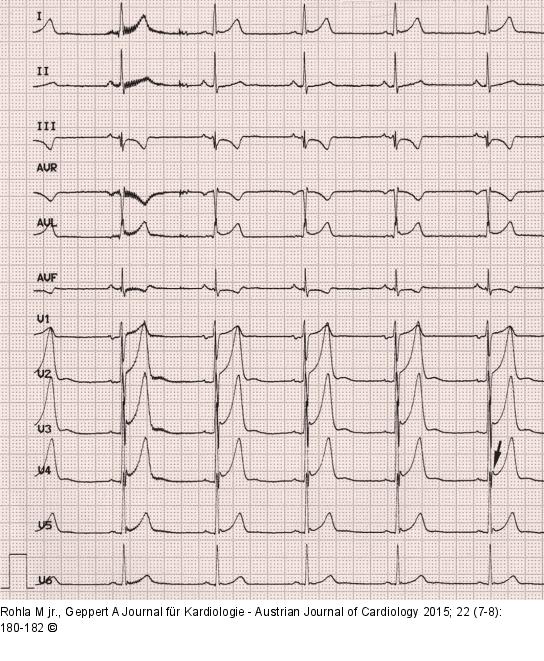 EKG