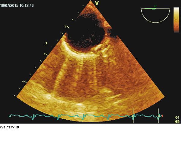 Plaque  - Aorta