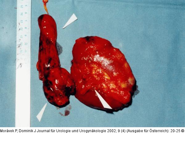 Nierenkarzinom - Tumorthrombose