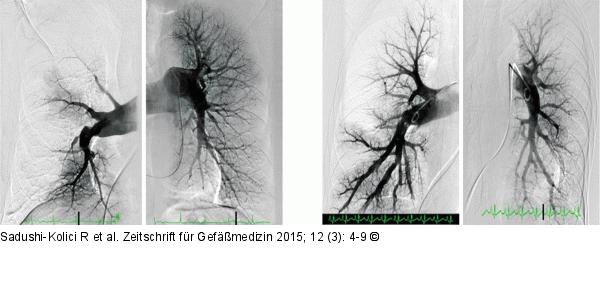 Pulmonalgefangiographie