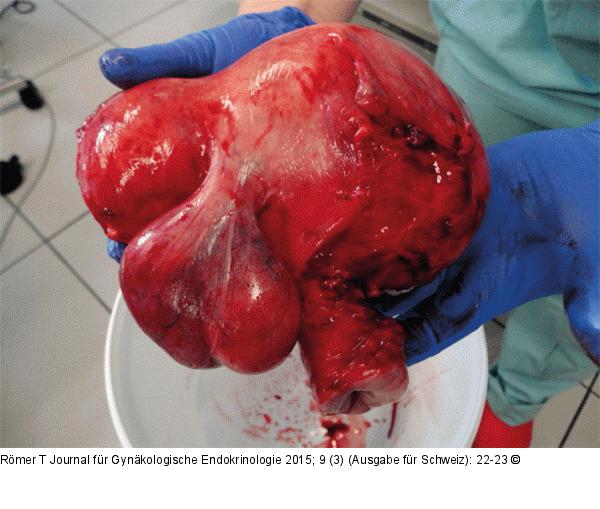 Uterus myomatosus