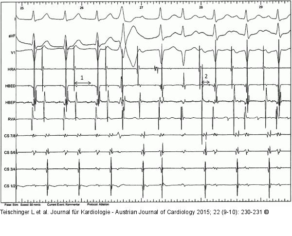 EKG