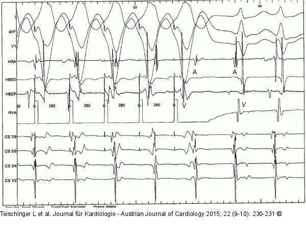 EKG