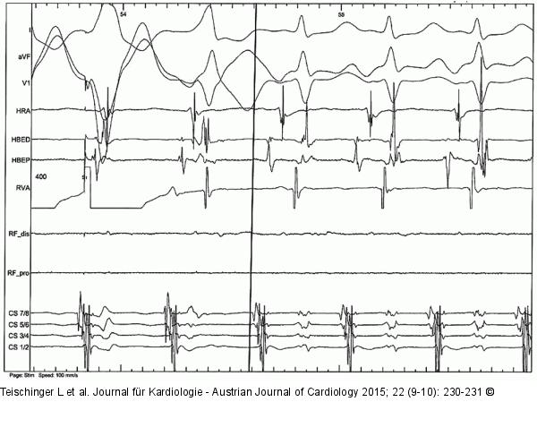 EKG