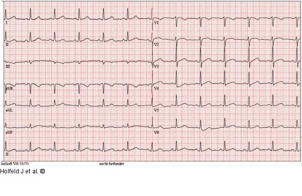 EKG