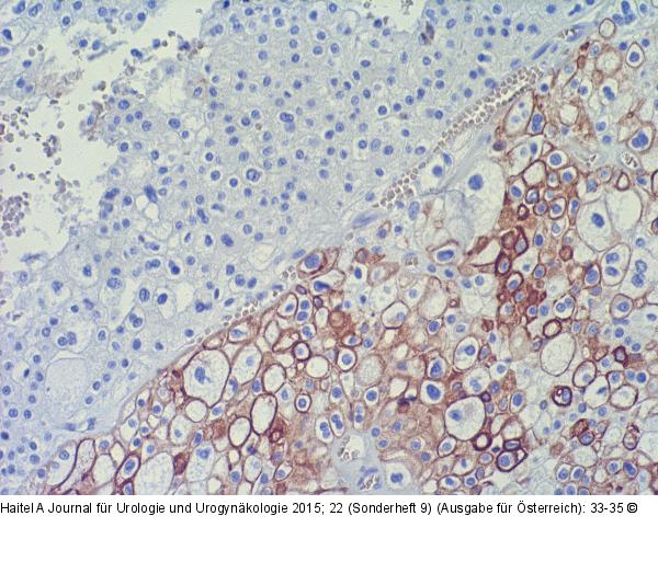 Nierenzellkarzinom-Pathologie
