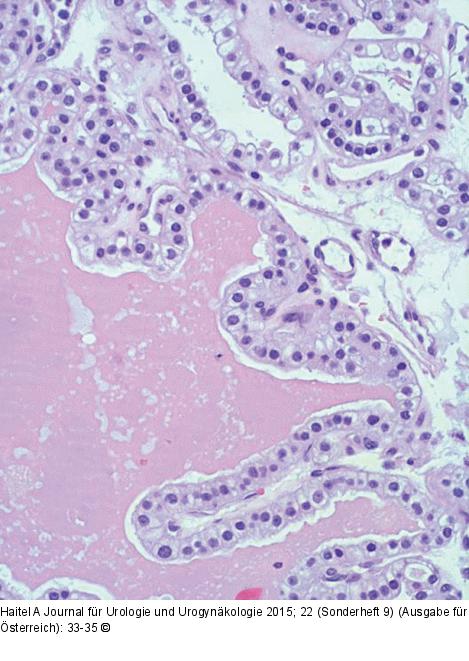 Nierenzellkarzinom-Pathologie