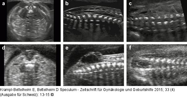 Spina bifida  Prnataldiagnose