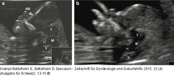 Spina bifida  Prnataldiagnose
