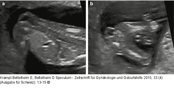 Spina bifida  Prnataldiagnose