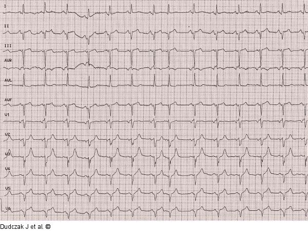 EKG