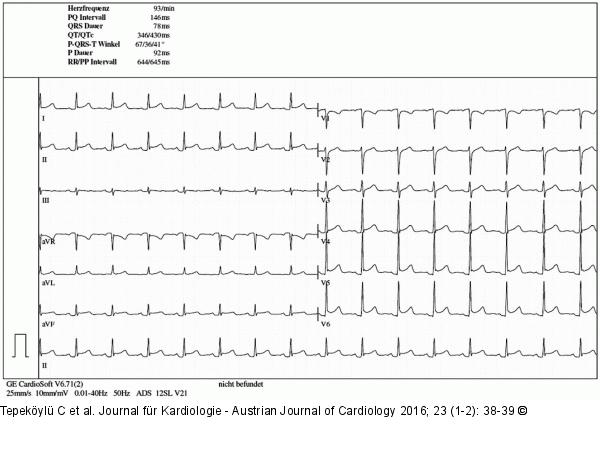 EKG