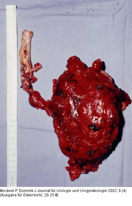Nierenkarzinom - Tumorthrombose