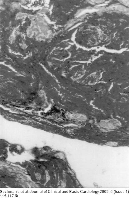 Thrombus - Histologie