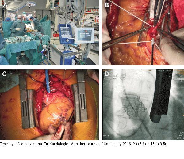 ECMO