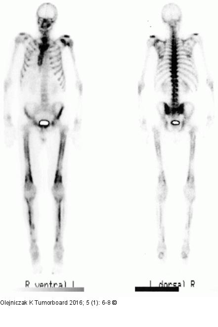 Hypertrophe pulmonale Osteoarthropathie