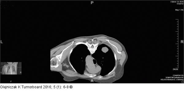 Hypertrophe pulmonale Osteoarthropathie