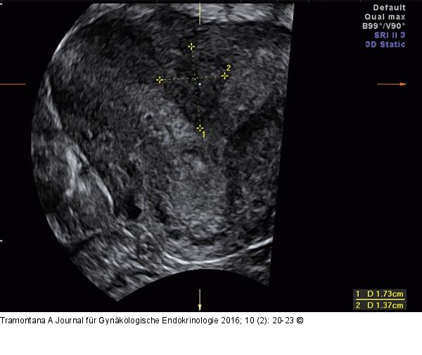 Uterus subseptus