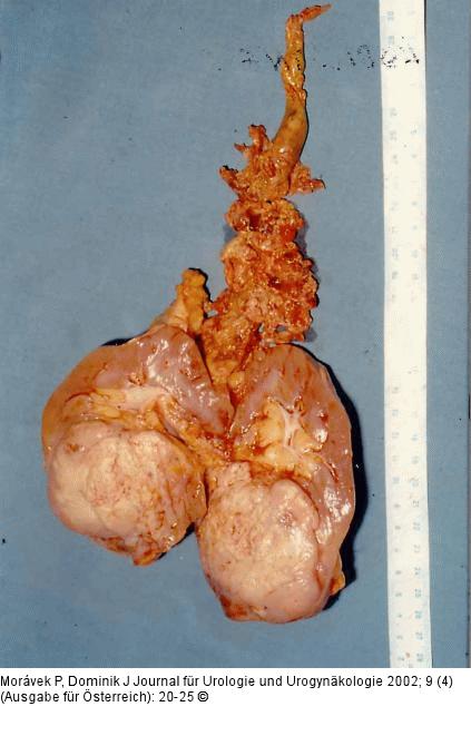 Nierenkarzinom - Tumorthrombose