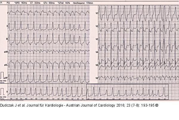 EKG
